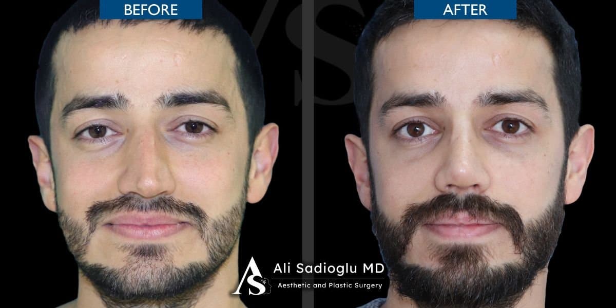 breast implant removal
