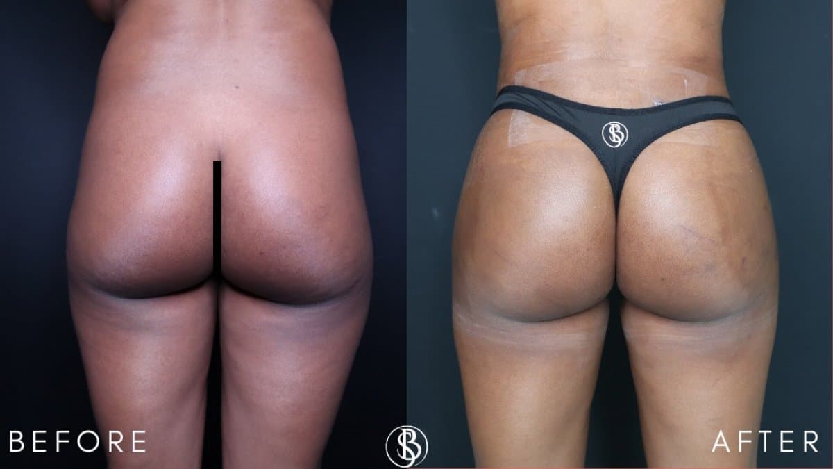 abdominal etching