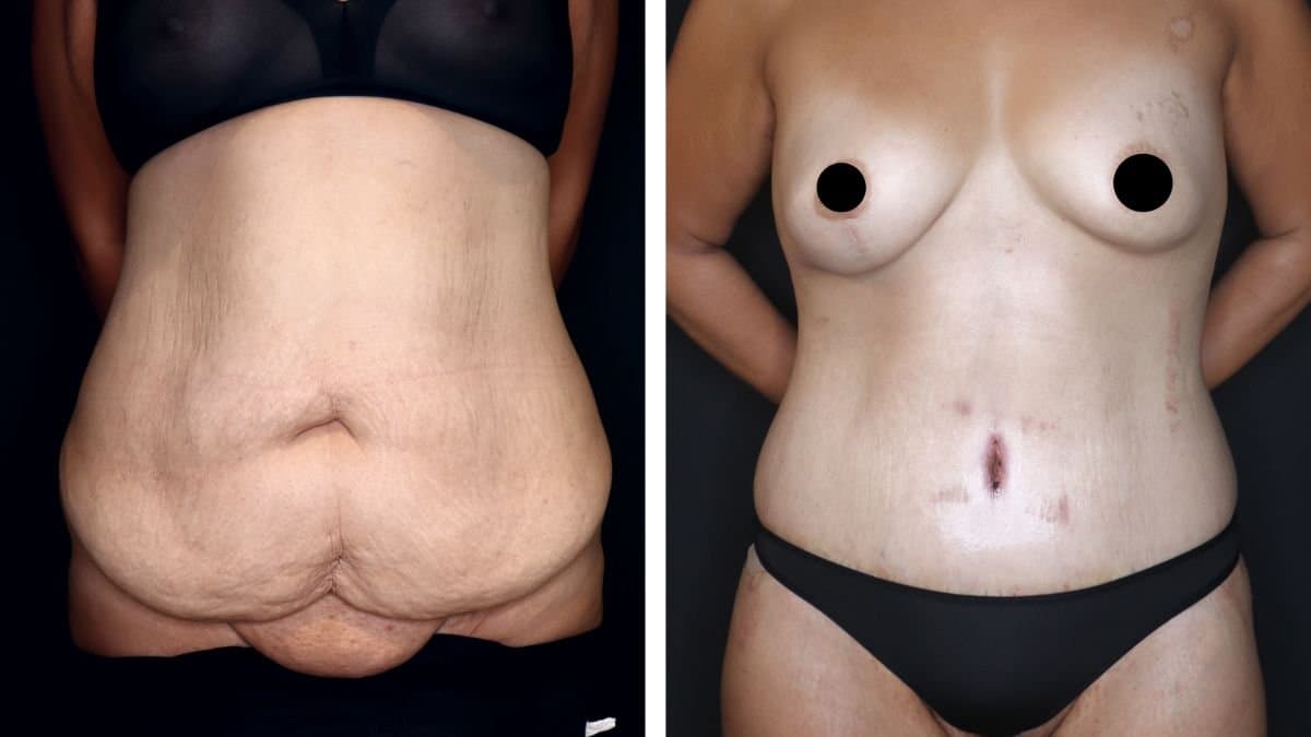 liposuction