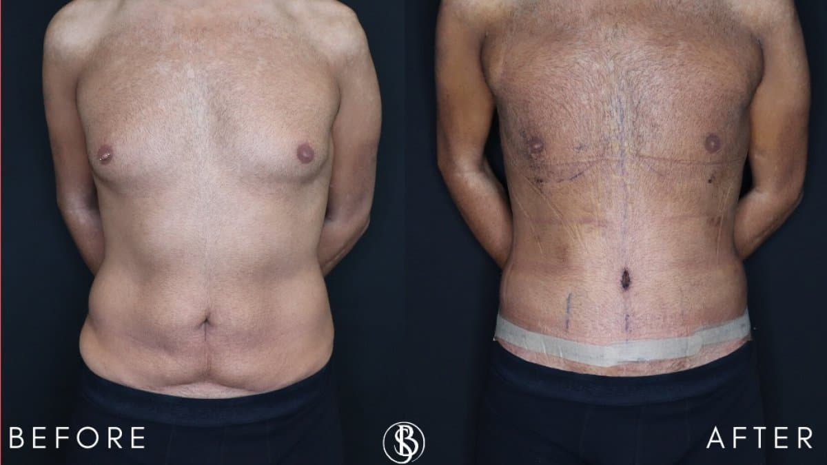abdominal etching