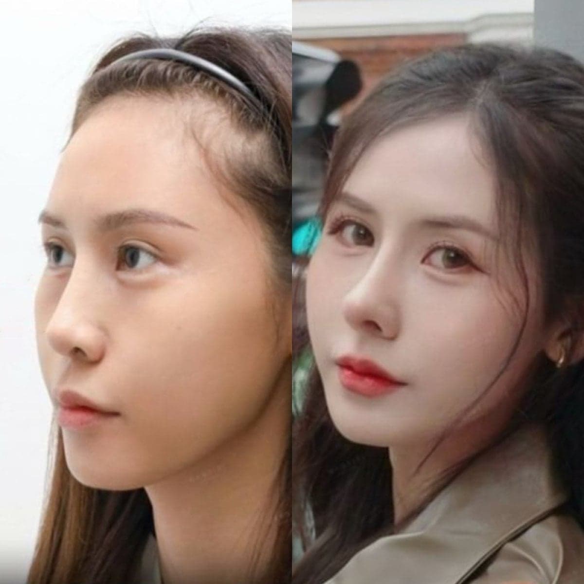 tip rhinoplasty