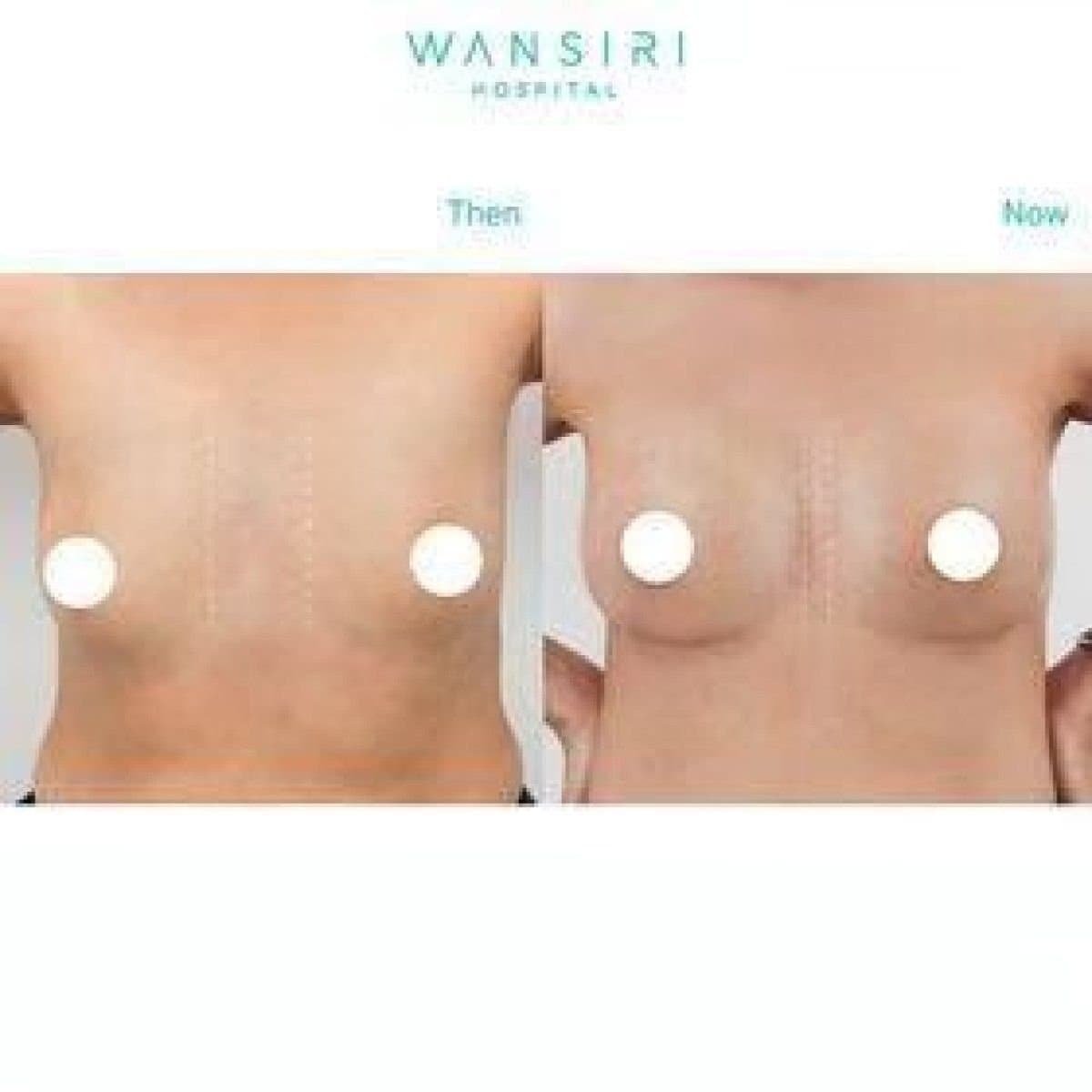 breast augmentation