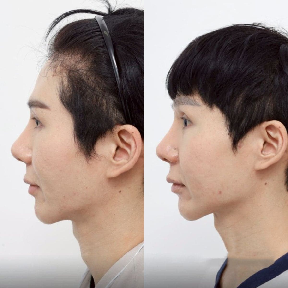 cheekbone reduction