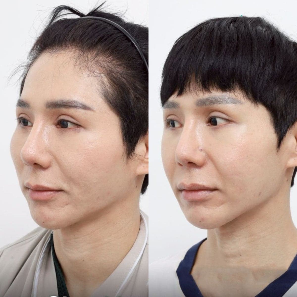 cheekbone reduction