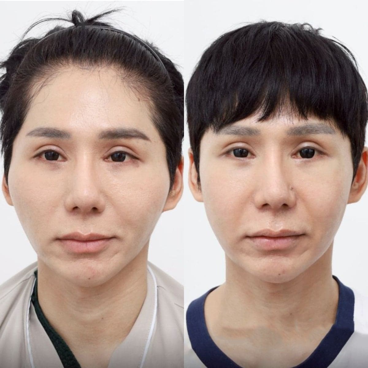 cheekbone reduction