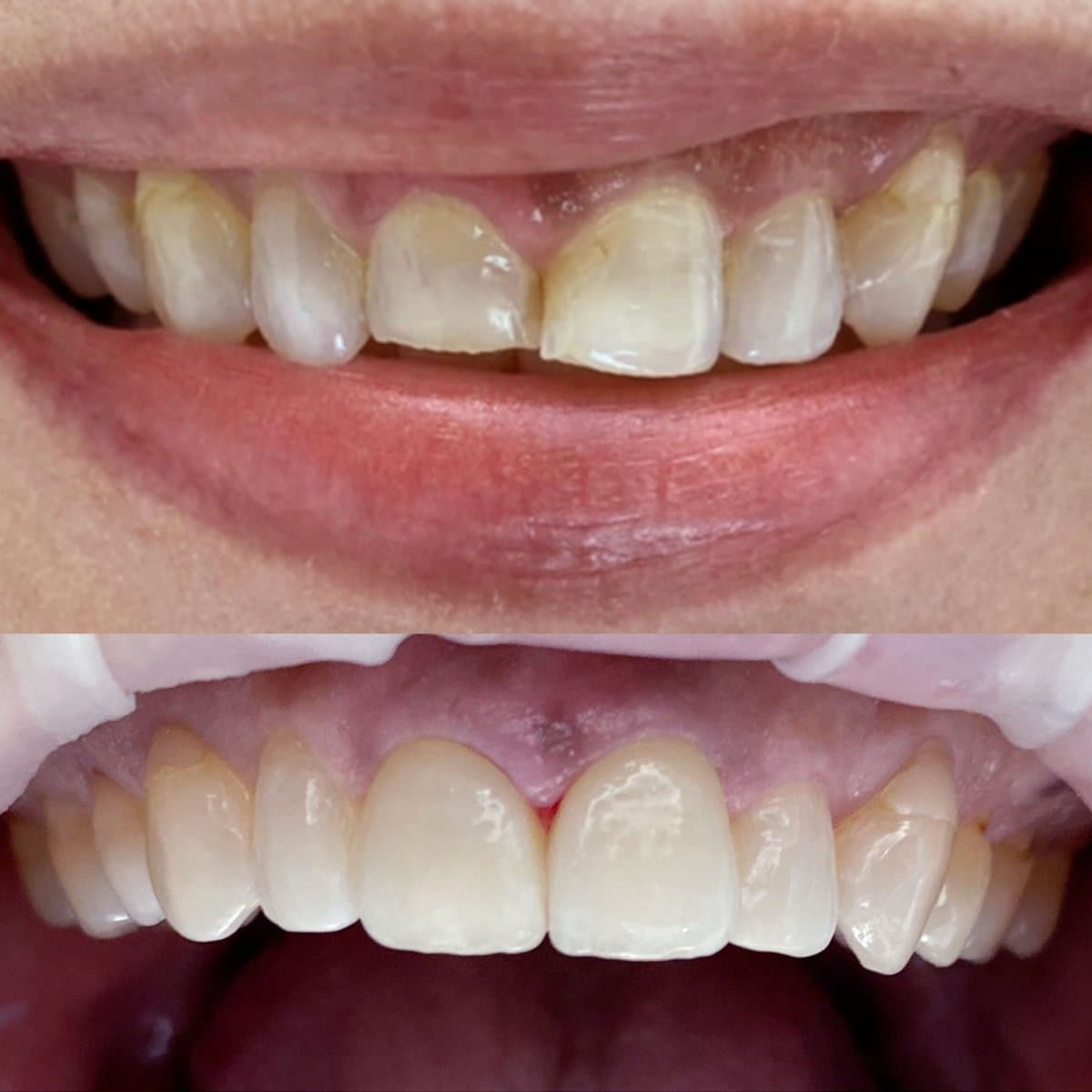 porcelain veneer