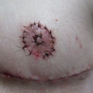 Masculinizing Top Surgery