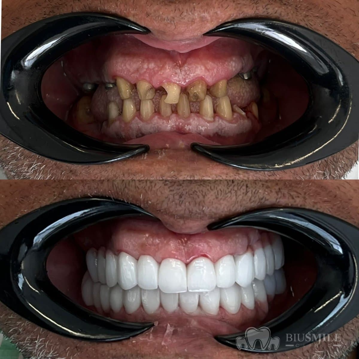 zirconia crown installation