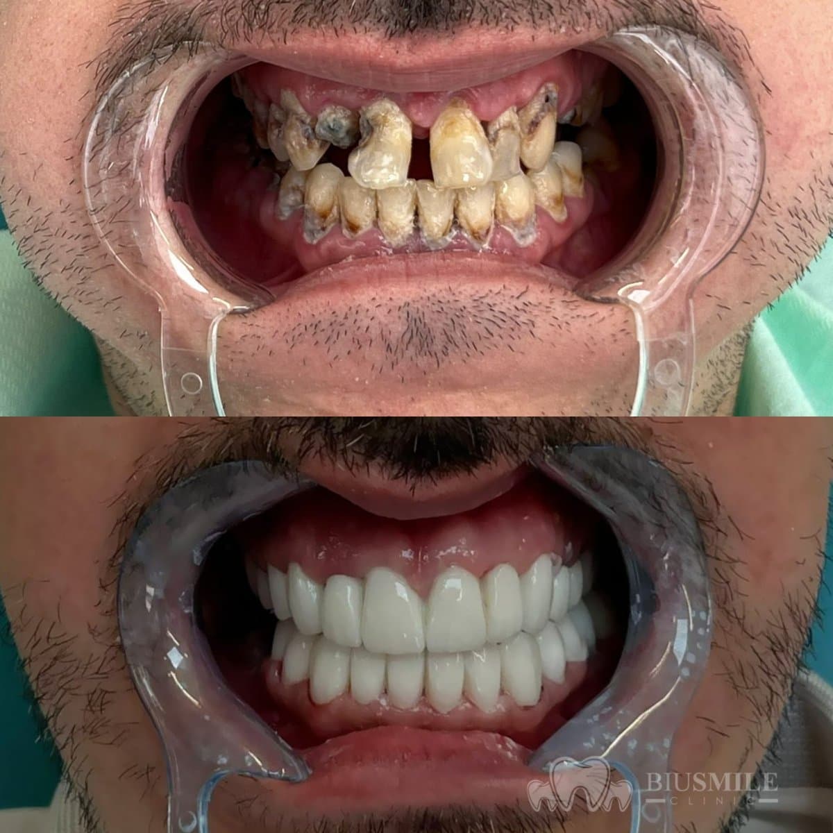 zirconia crown installation