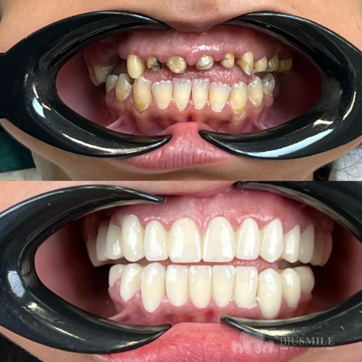 zirconia crown installation