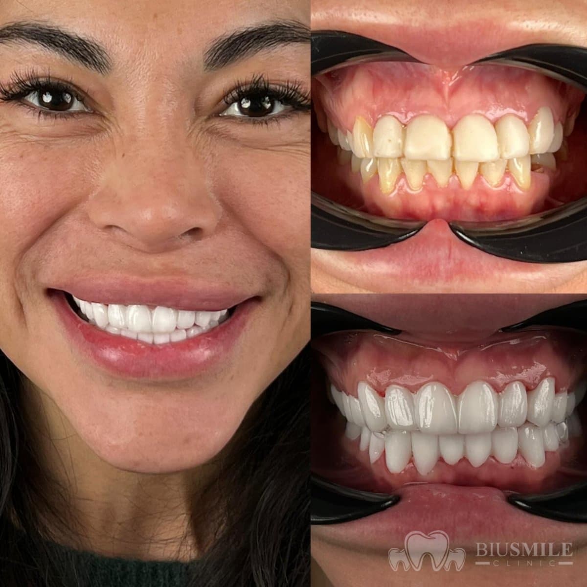 zirconia crown