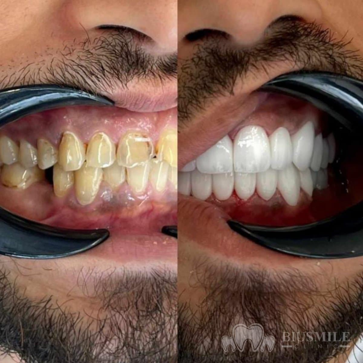 zirconia crown installation