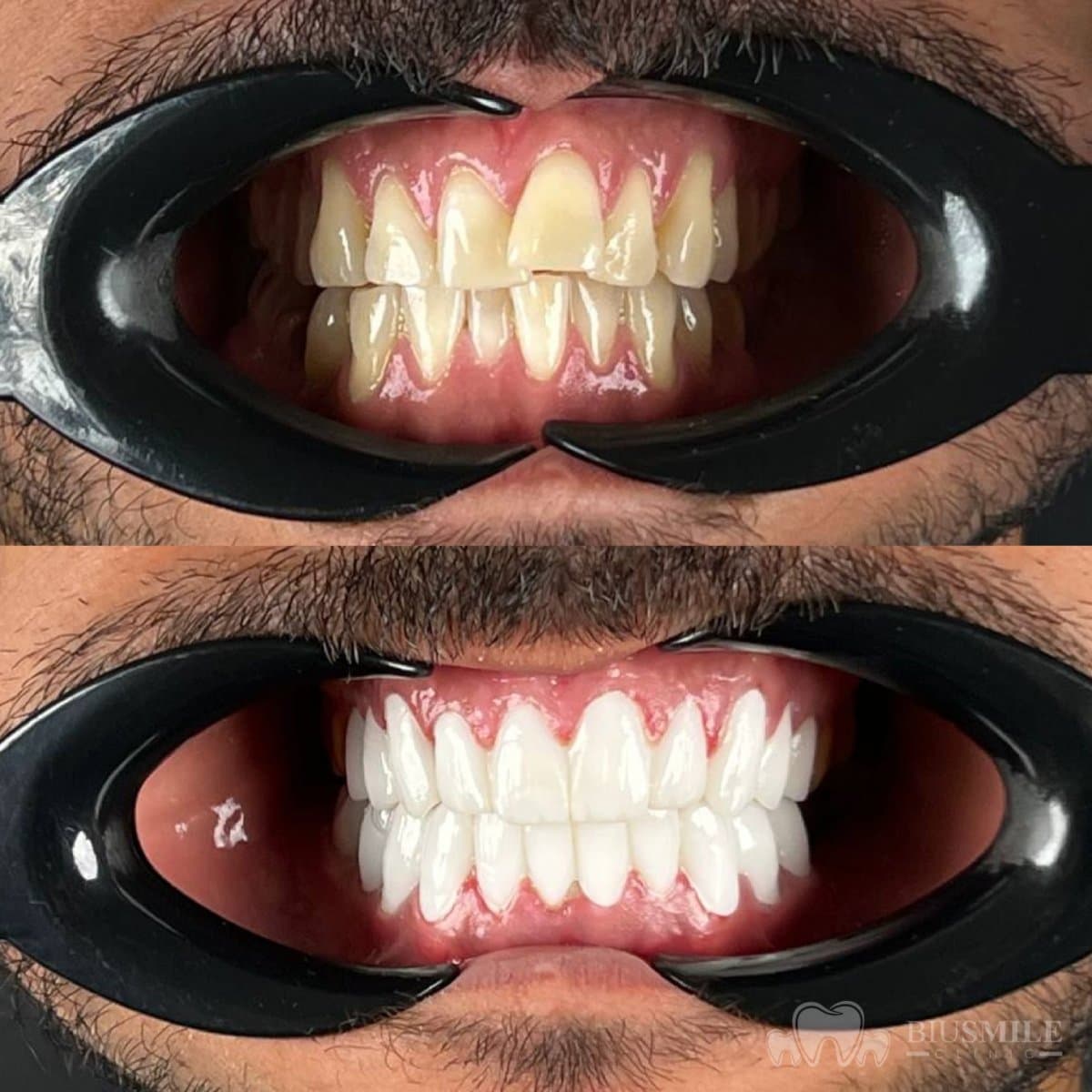 zirconia crown installation