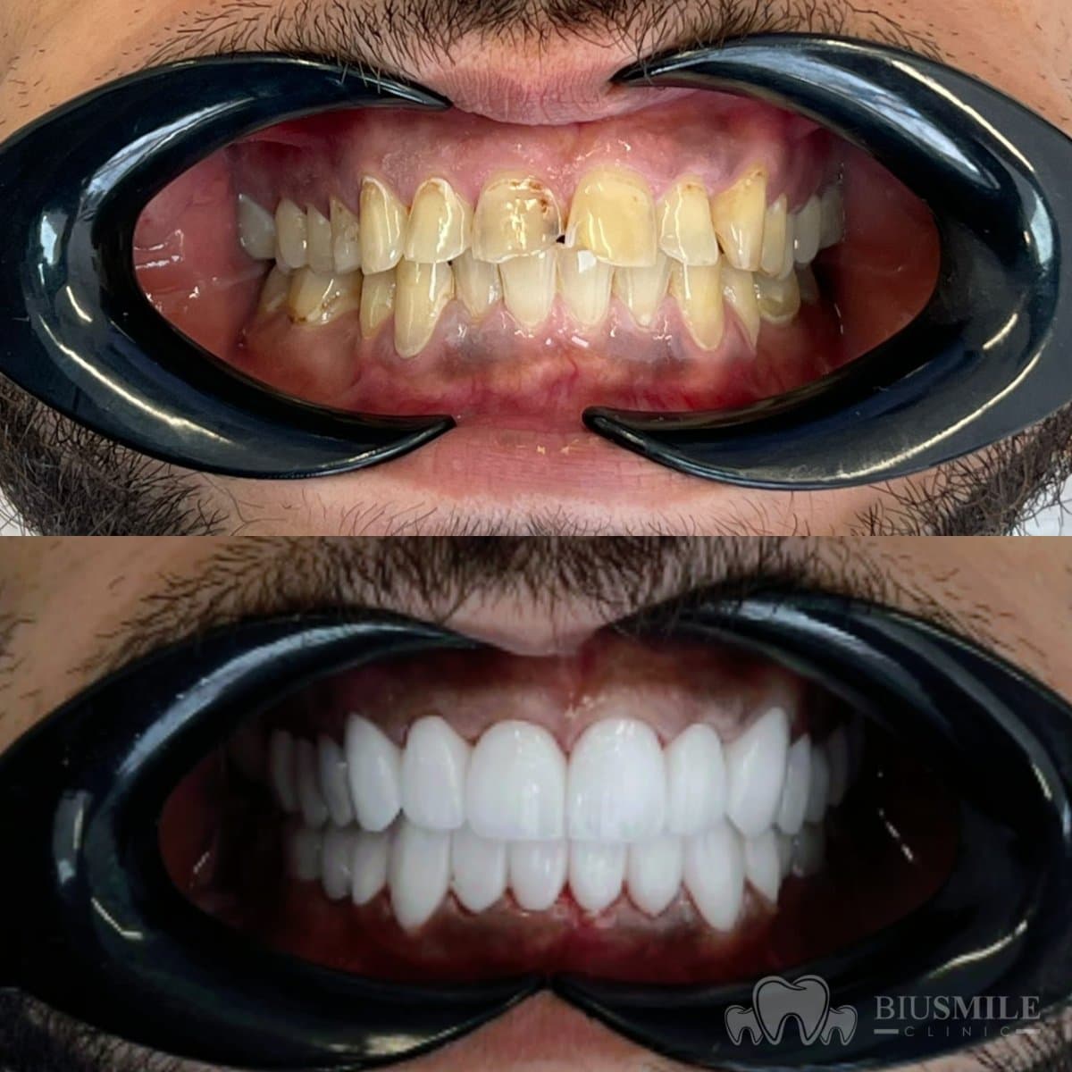 zirconia crown installation