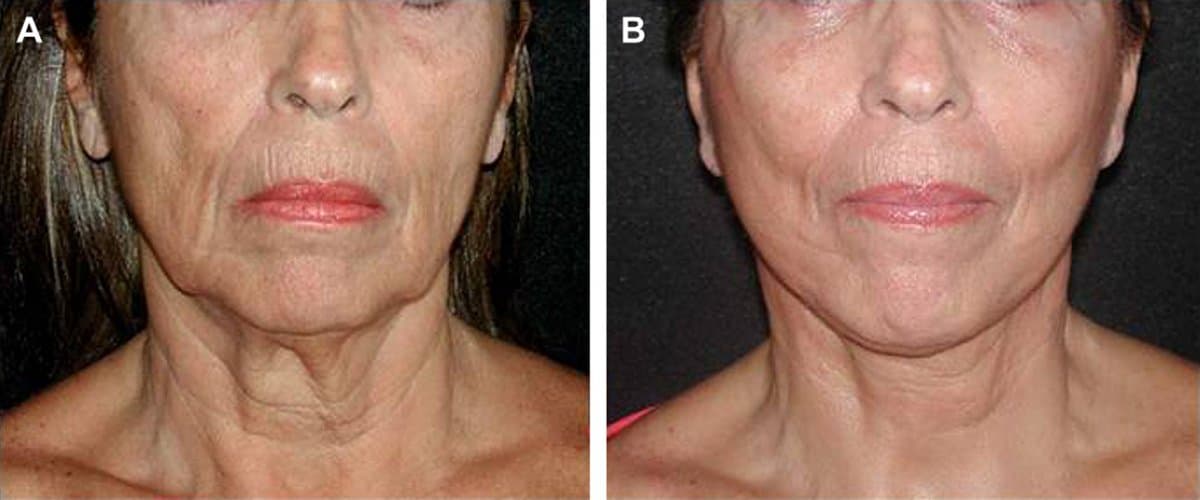 neck lift