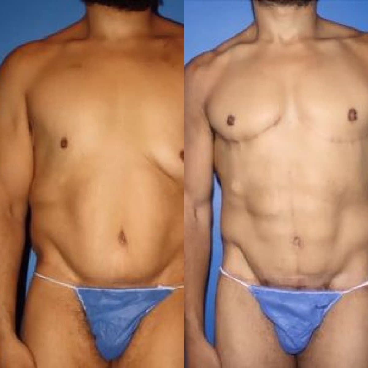 lipofilling