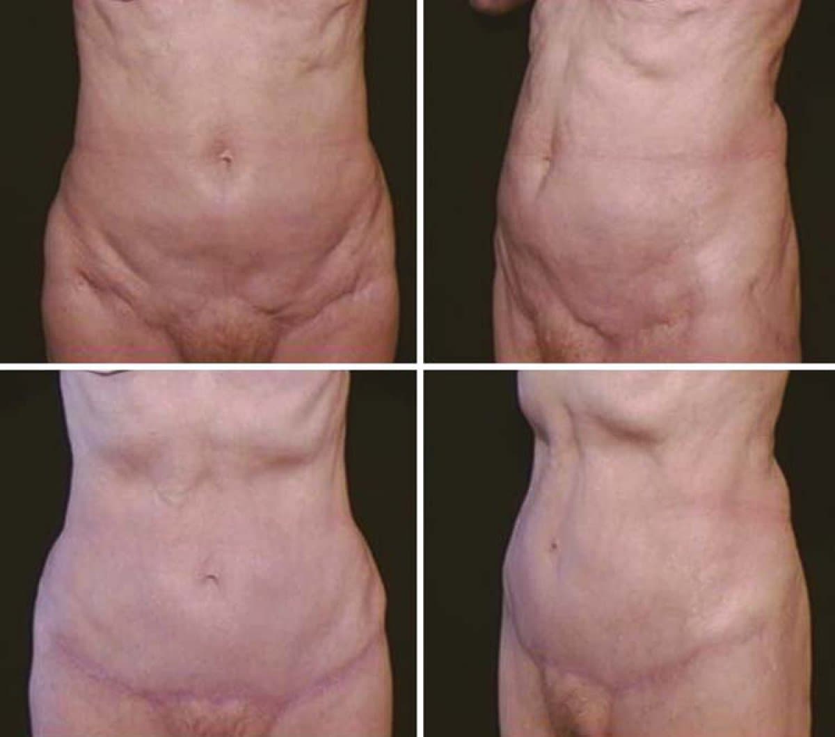 tummy tuck