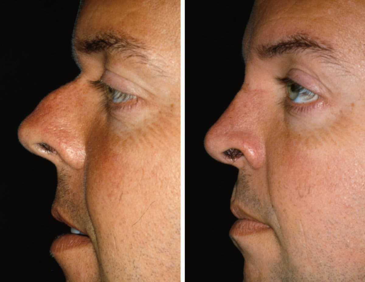 rhinoplasty