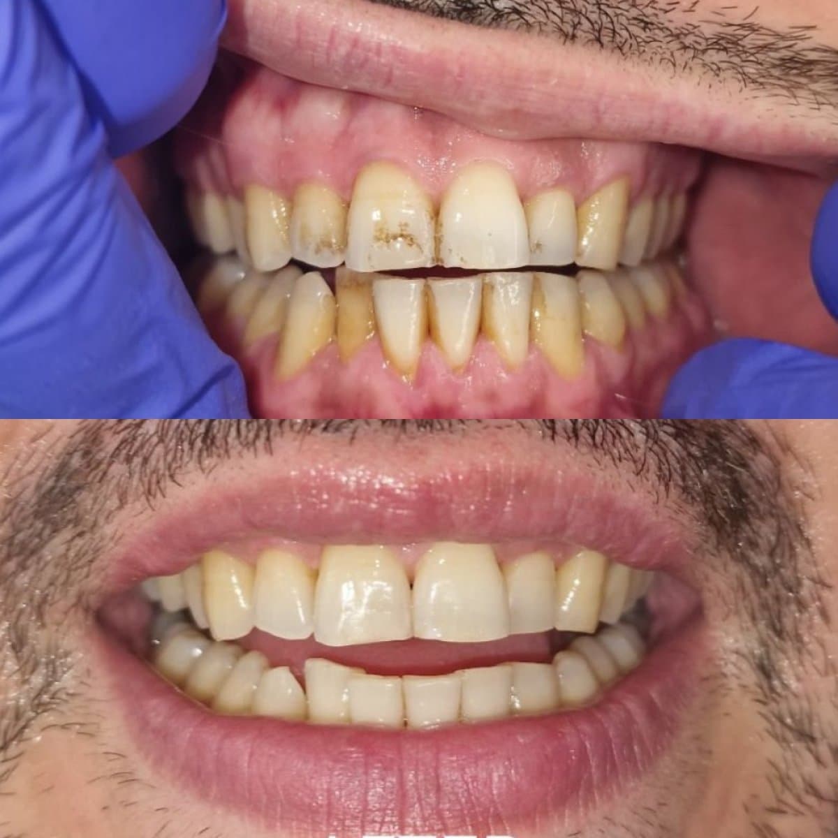 teeth cleaning (scaling)