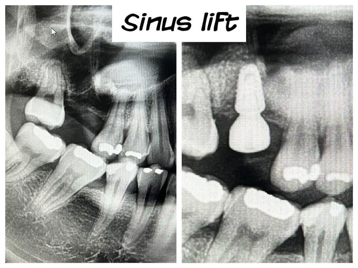 sinus lift with dental implants
