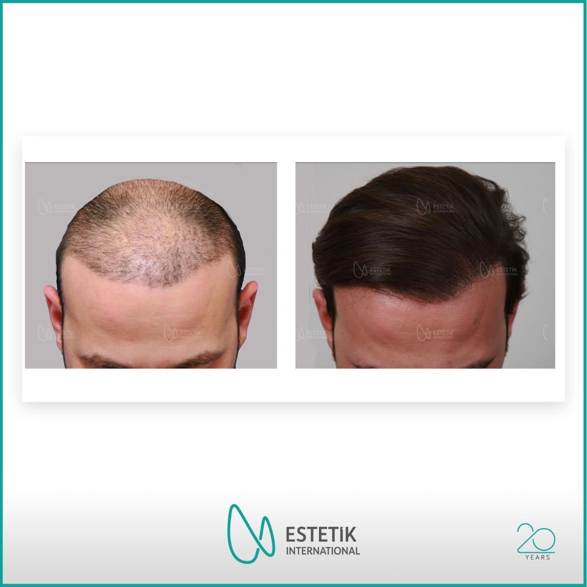 FUE hair transplant