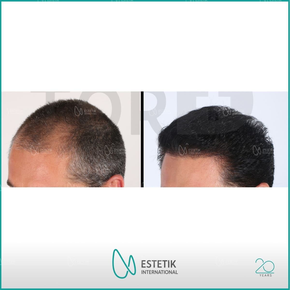FUE hair transplant