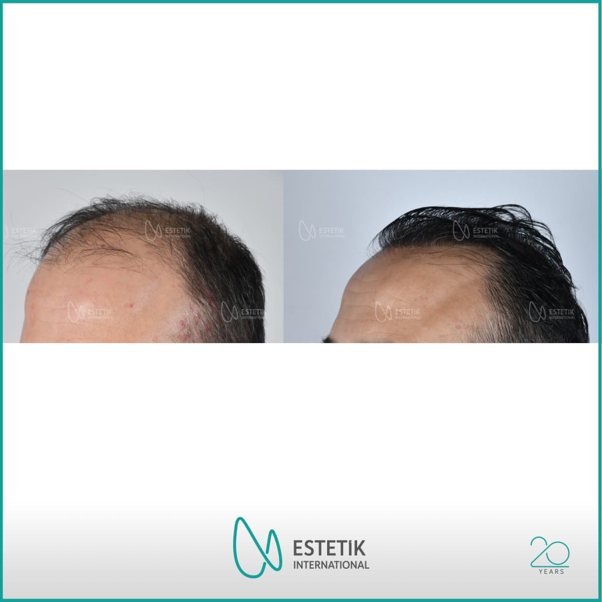 hair transplant