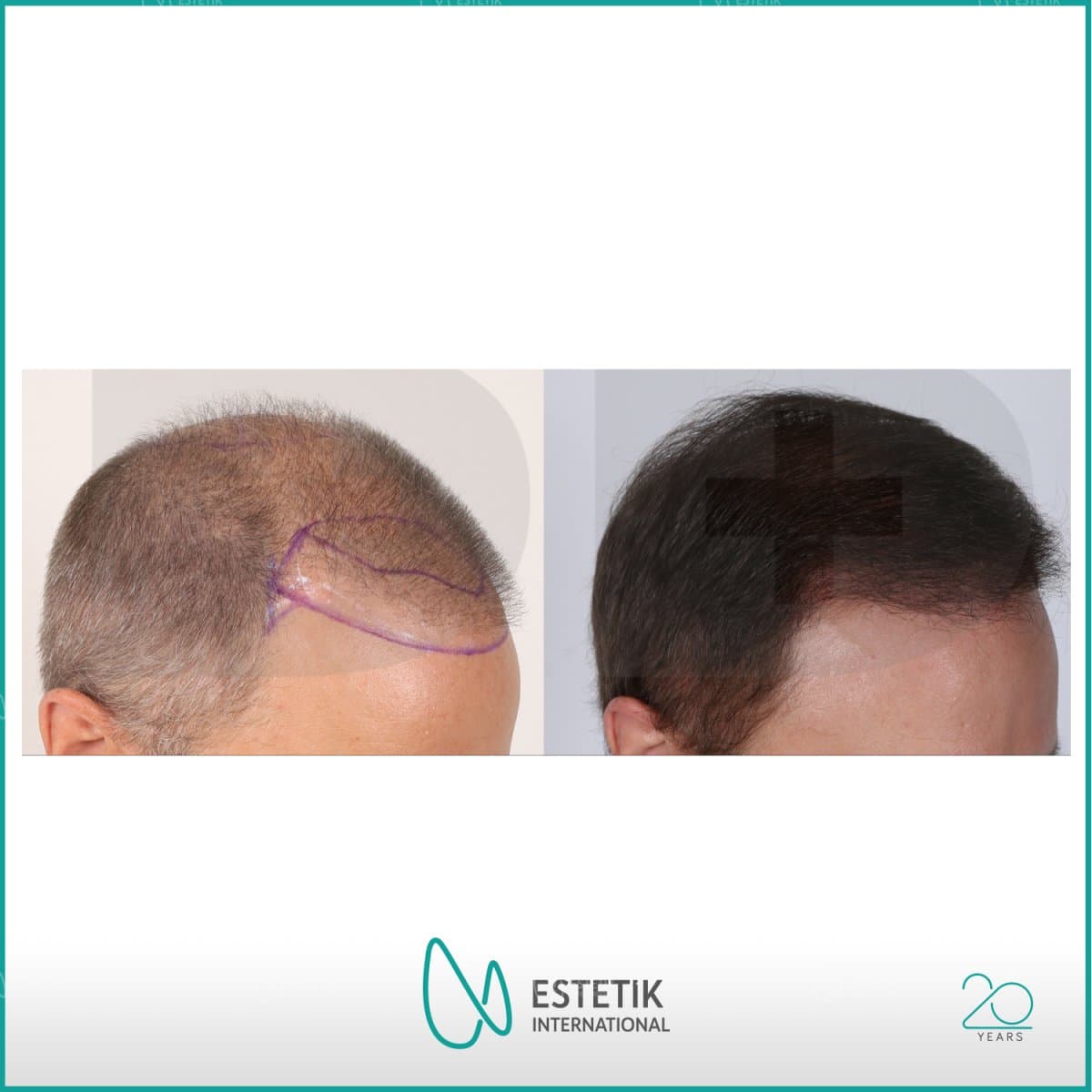 hair transplant