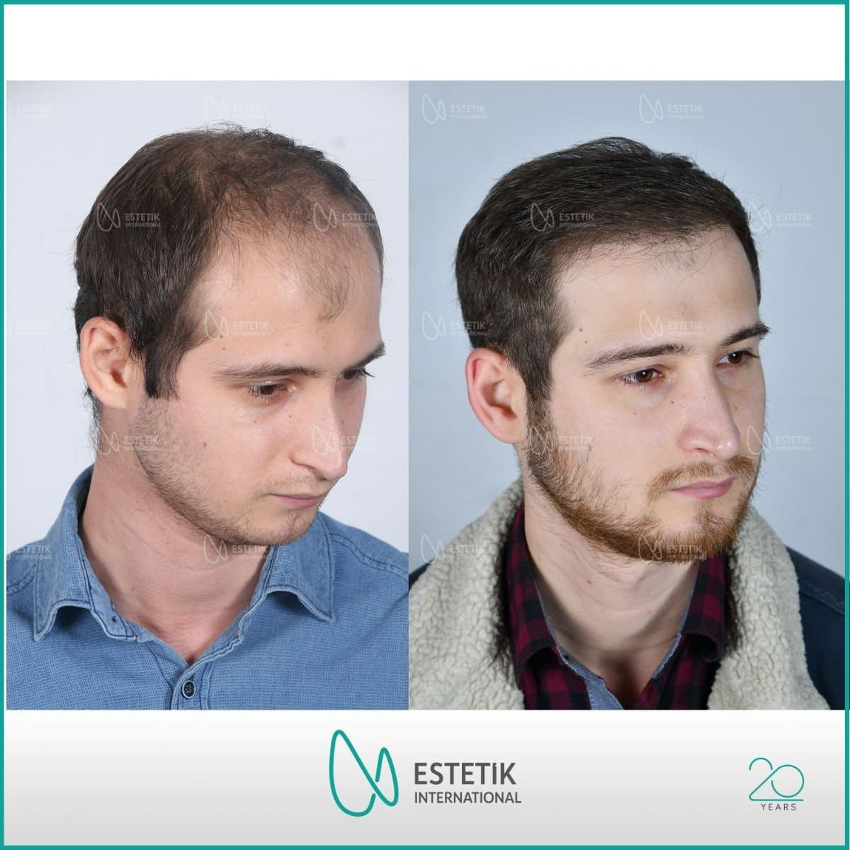 FUE hair transplant