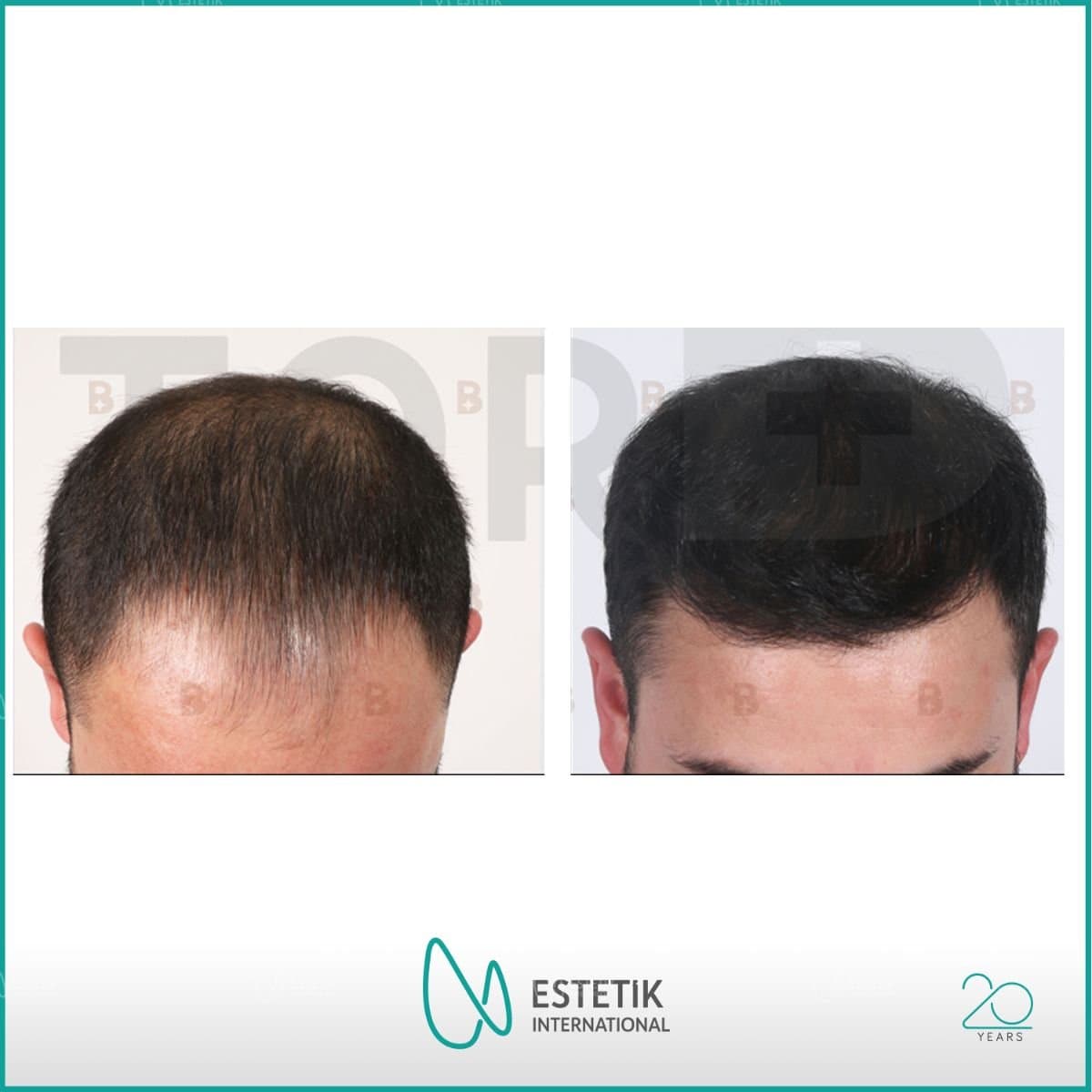 FUE hair transplant