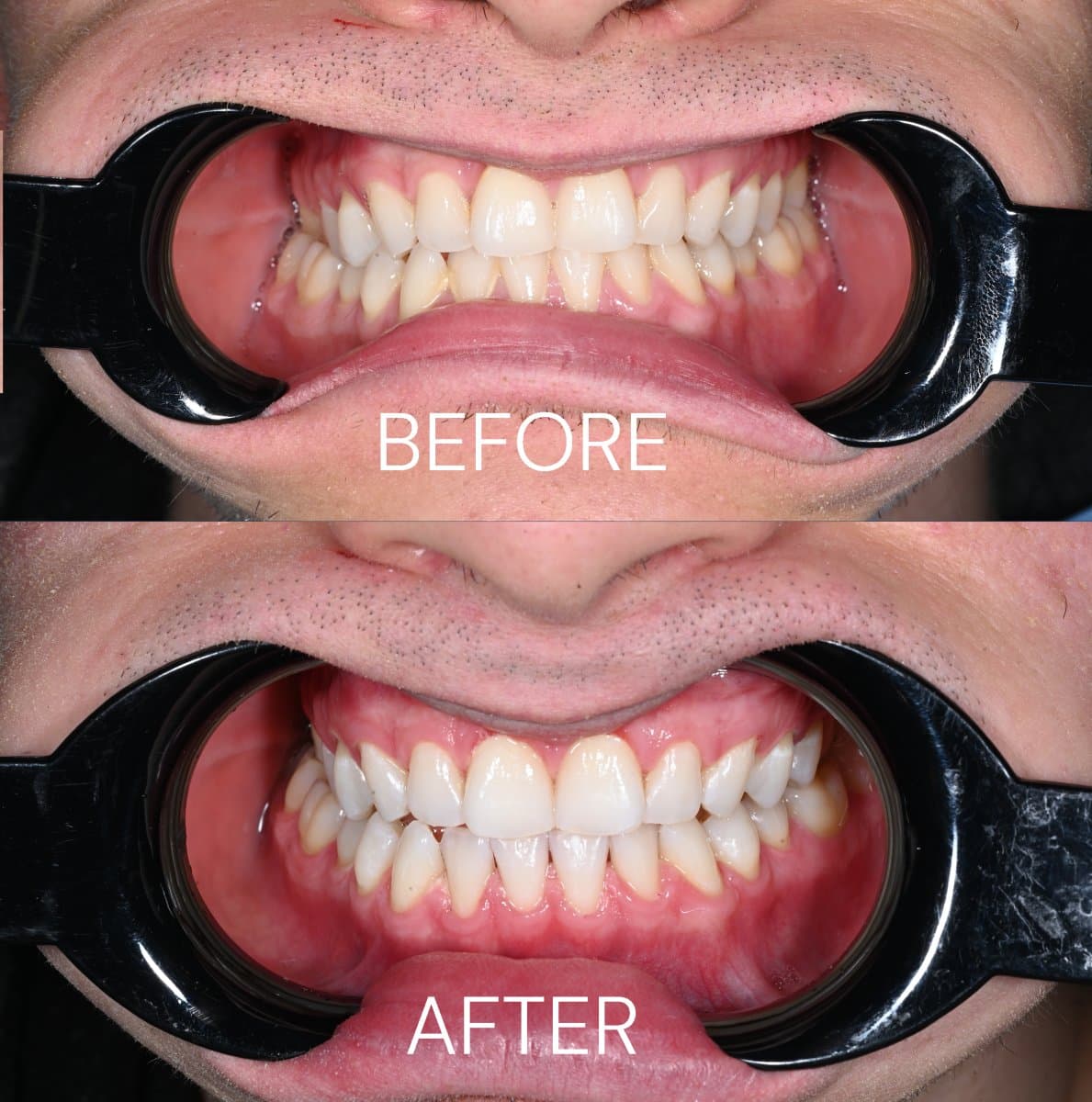teeth cleaning (scaling)