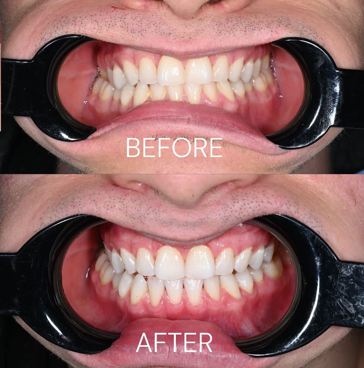 tooth whitening