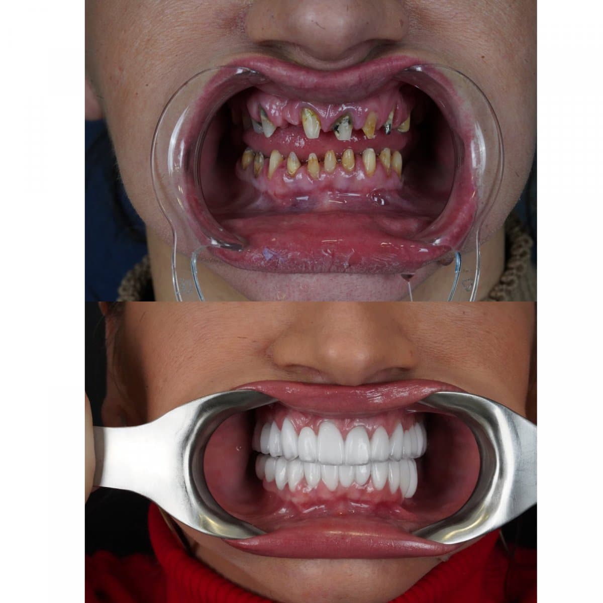 zirconia dental bridge