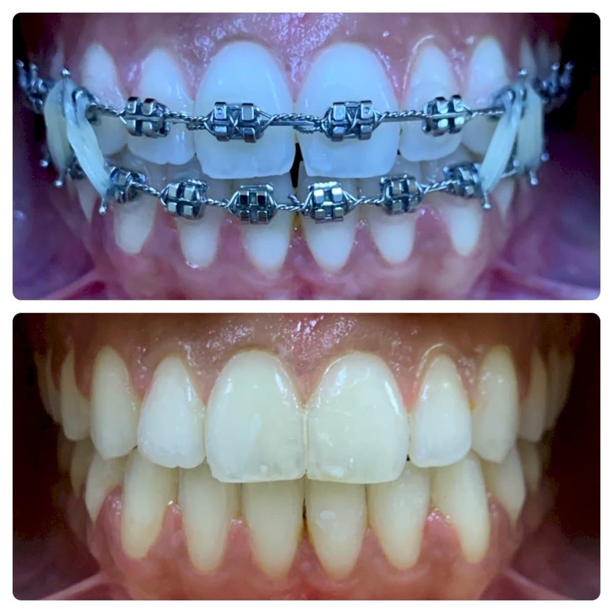 braces