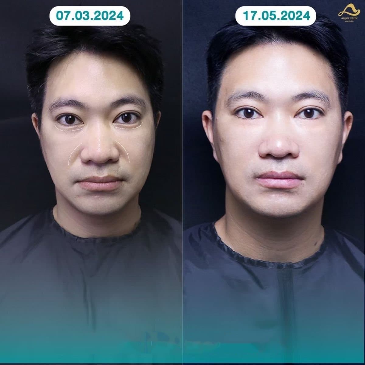 nonsurgical facelift