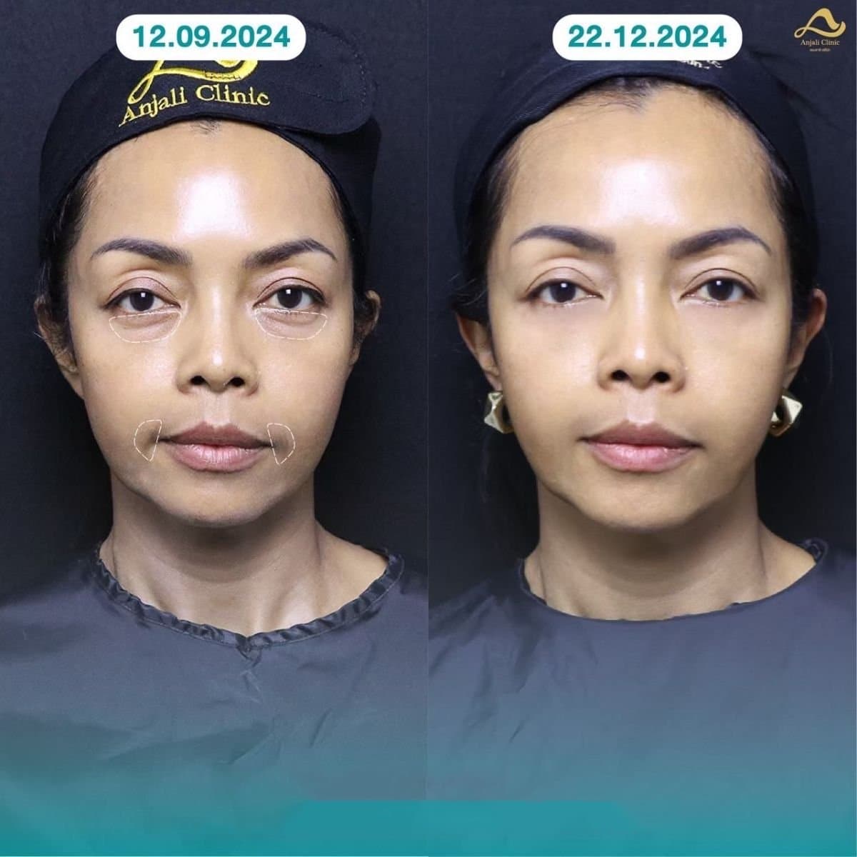 nonsurgical facelift