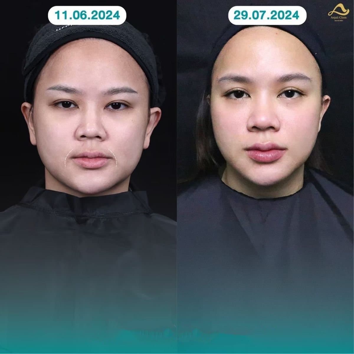 nonsurgical facelift