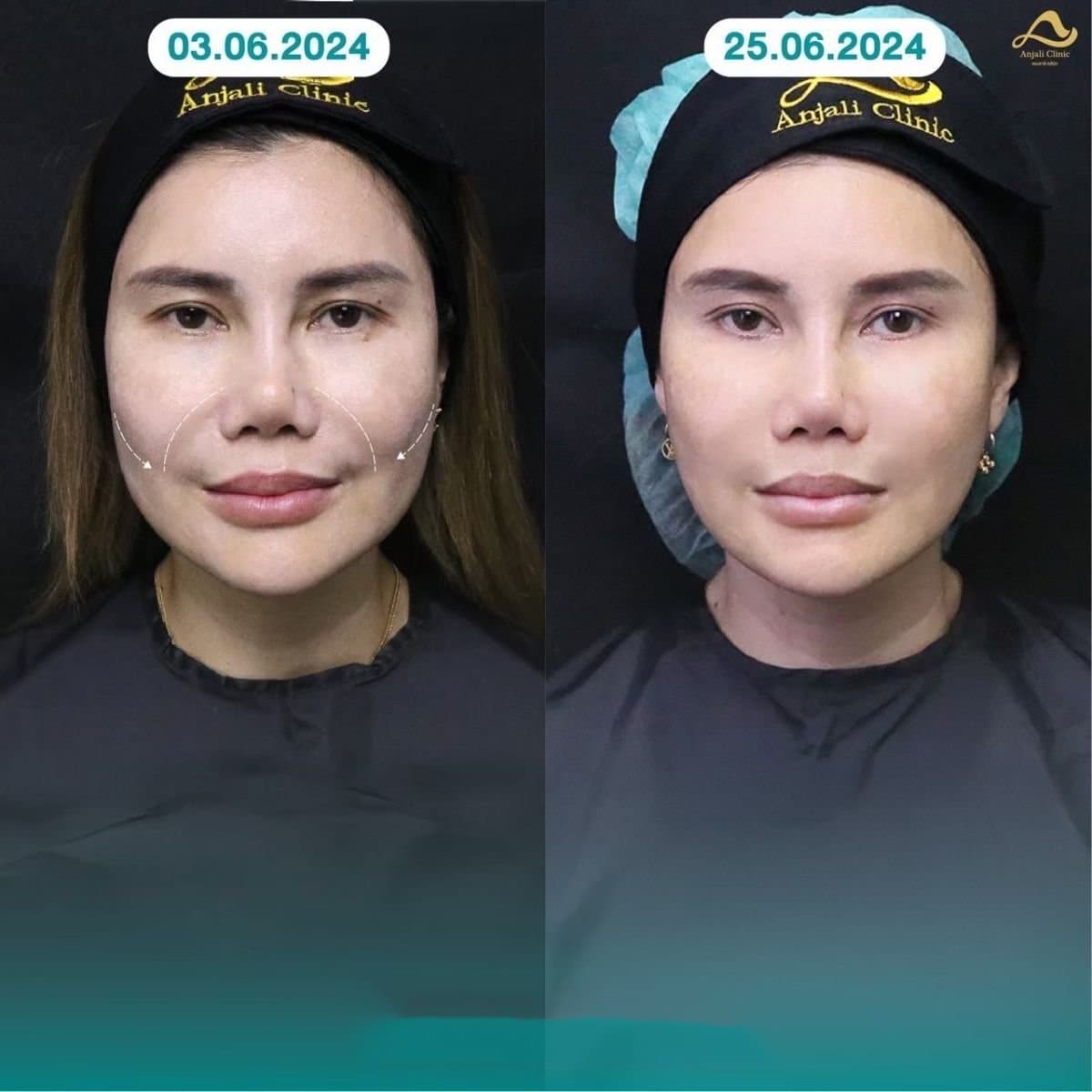 nonsurgical facelift
