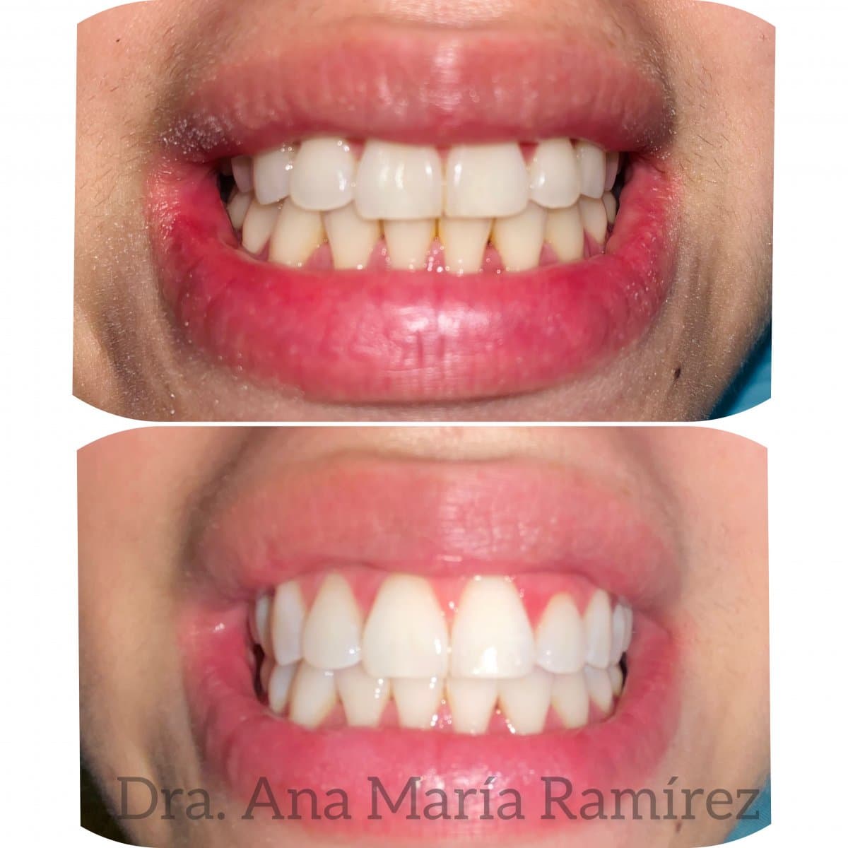 tooth whitening