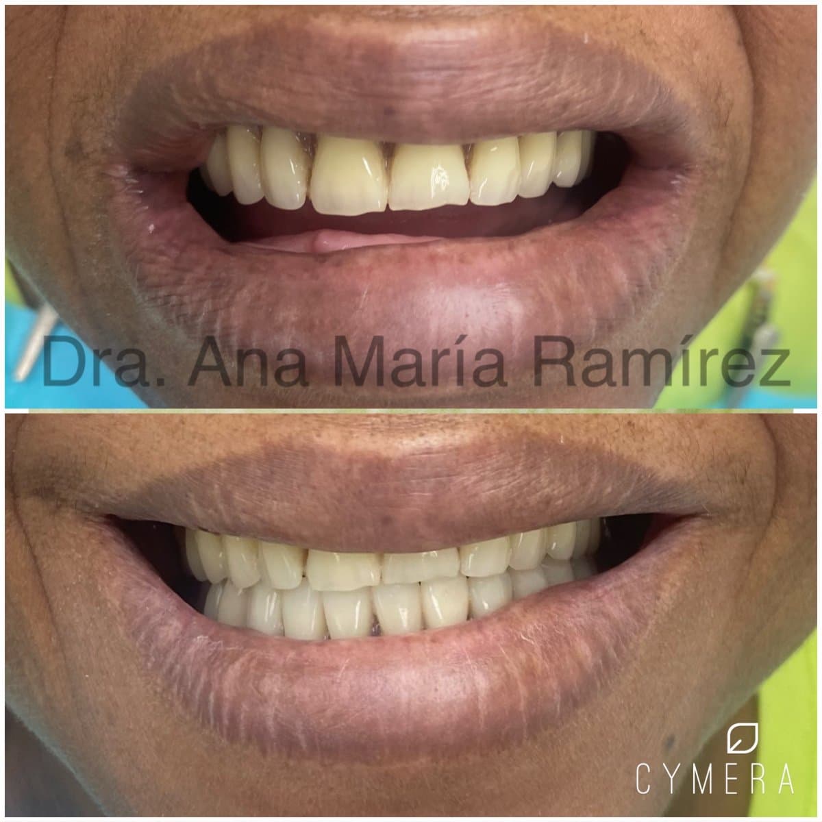 full dentures installation