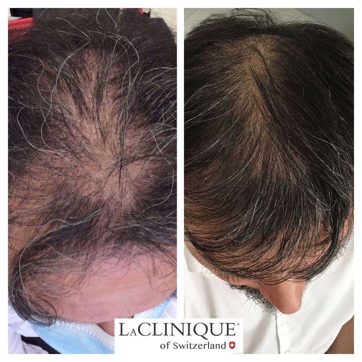 hair mesotherapy