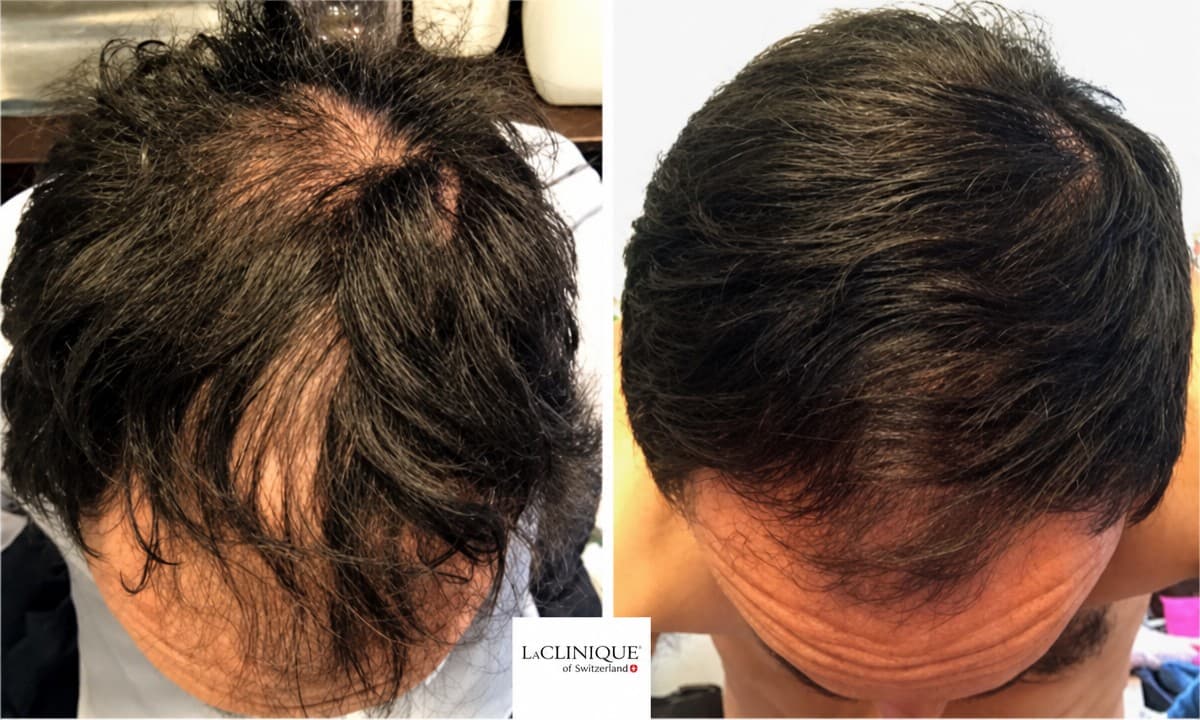 hair mesotherapy