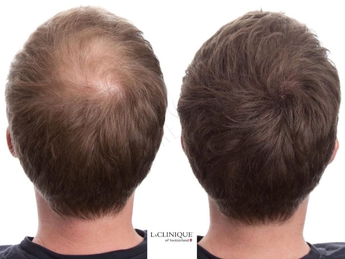 hair mesotherapy