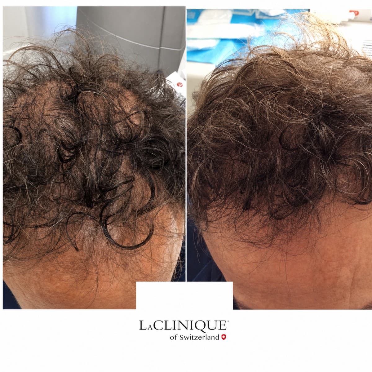 hair mesotherapy
