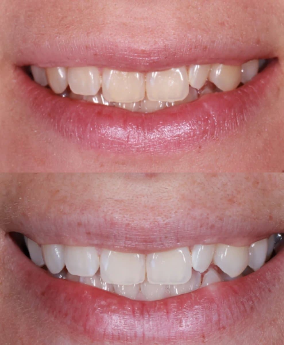 teeth cleaning (scaling)