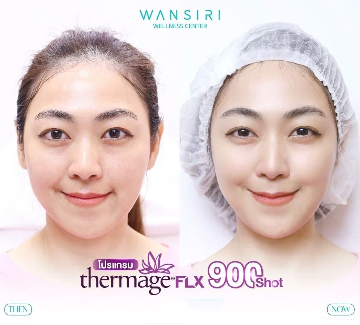 Thermage FLX