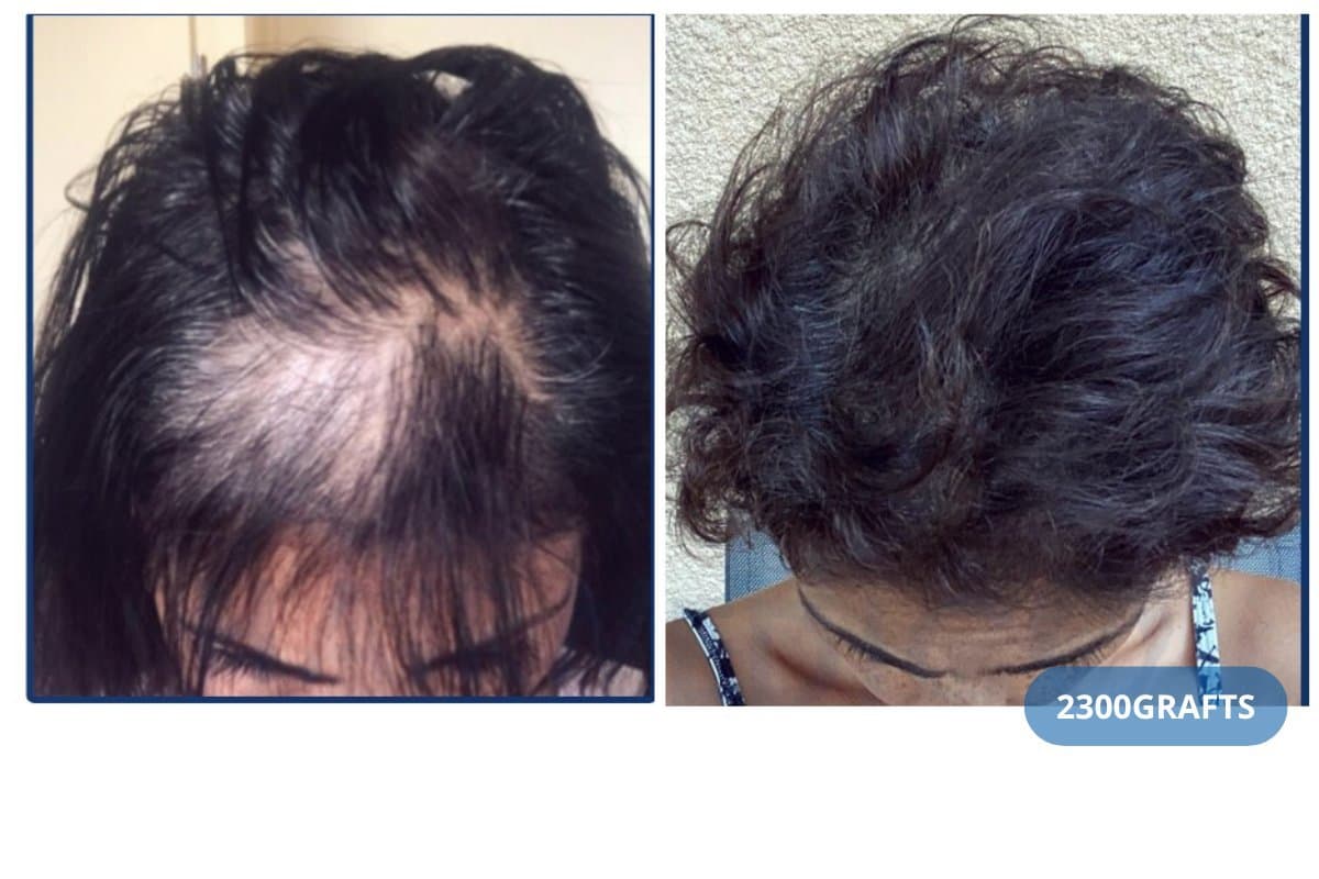 DHI hair transplant