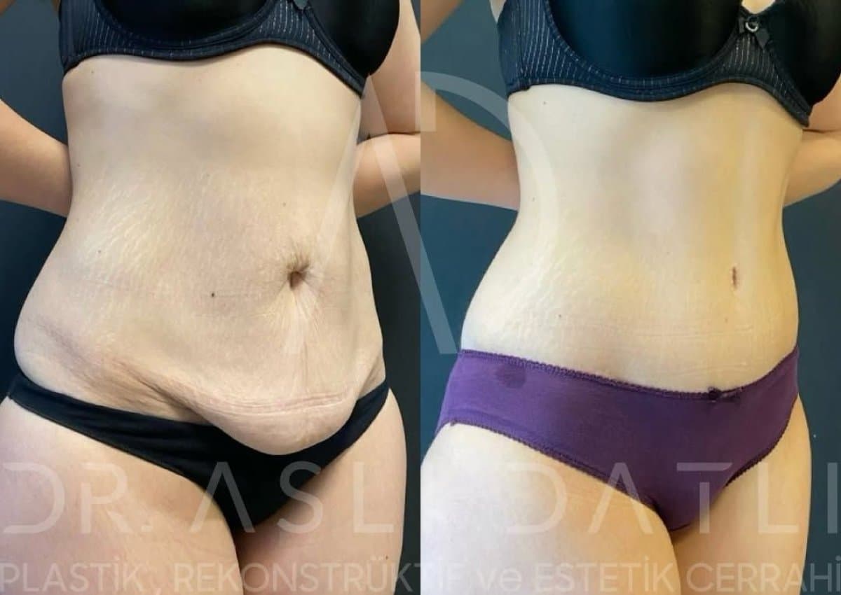 BodyTite body contouring