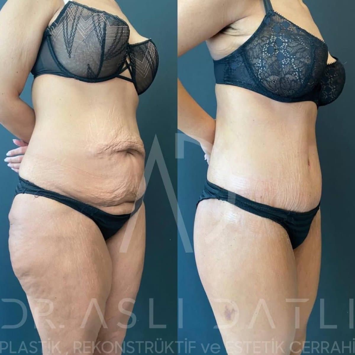 360 liposuction