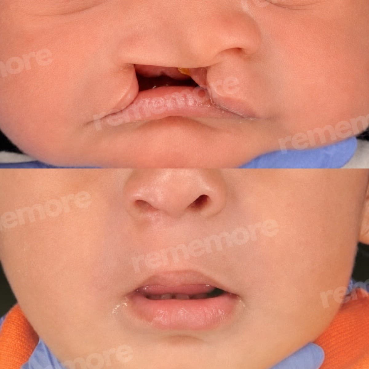 cleft lip repair